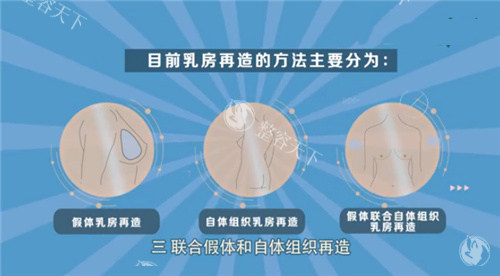 乳房再造手术方式