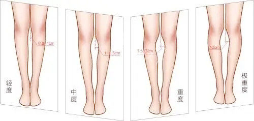 腿型矫正对比图