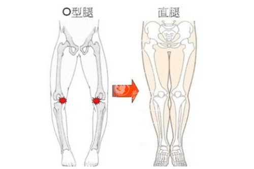 腿型矫正图对比