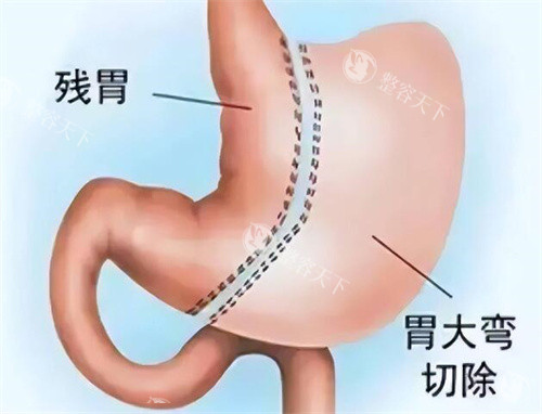 分享切胃减肥亲身经历:手术前后体重变化大,生活饮食调整,我的真实感受和建议!