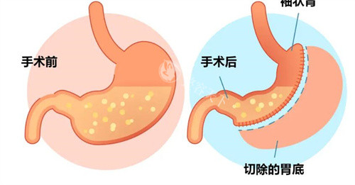 袖状胃切除手术前后对比卡通