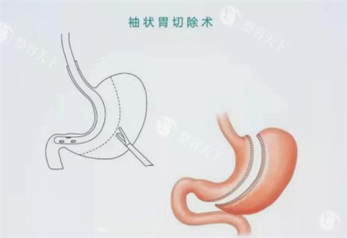 袖状胃切除手术卡通示意图