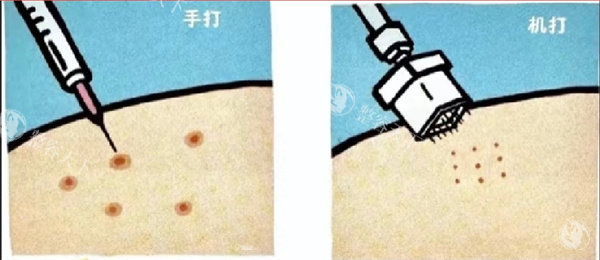 水光注射注射