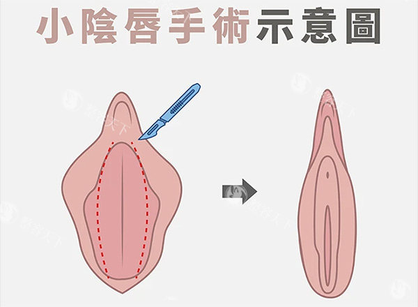 小阴唇整形前后对比
