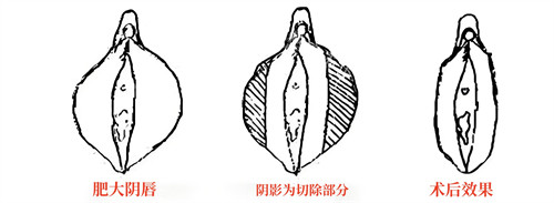 小阴唇肥大直接切除法演示动画图