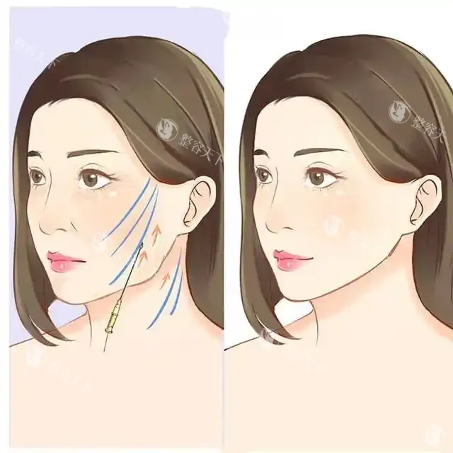 拉皮除皱手术