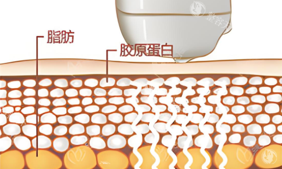 BodyTite射频溶脂做完一周就能看到结果？以色列进口仪器真实体验分享，瘦身塑形必看攻略！