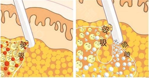 正规医院有吸脂手术吗?探讨正规途径吸脂手术的适用人群和注意事项
