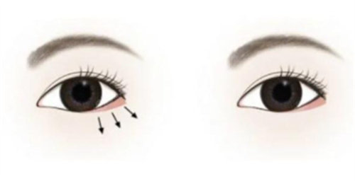 上眼睑提肌手术图解：手术步骤、修复过程及术后结果全解析，快速了解！