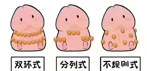 入珠术真实感受是什么？亲历者分享术前顾虑、术中体验、术后恢复及实际感受