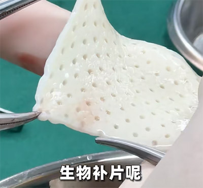 生物补片能增粗多少厘米？实测真相：术后直径增加1-4毫米，多层叠加成效更显著但需评估风险！