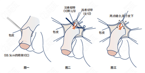 成都做私密延长手术多少钱？男性/女性项目全解析，较低5000元起！