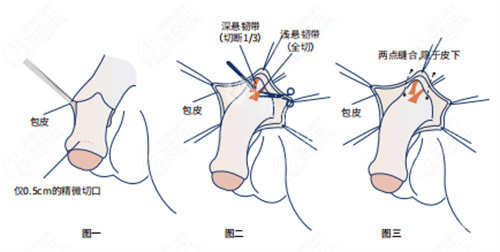 阴茎增长手术详细步骤演示动画图