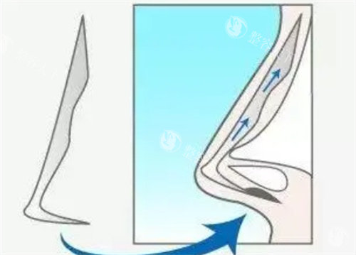 鼻假体