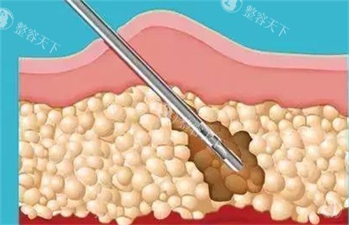 宋华敬和浦小宾抽脂谁腻害？过来人经验：腰腹环吸找宋华敬，面部吸脂找浦小宾更靠谱！