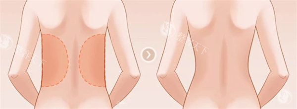 背部吸脂