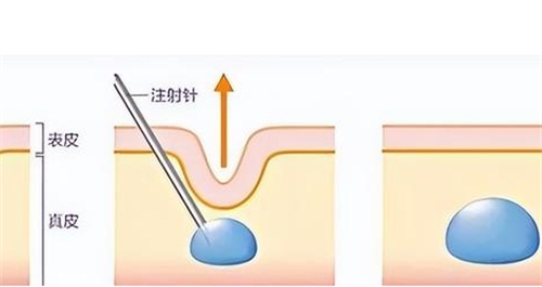 玻尿酸一针700能打吗?解析价格背后关键因素:品牌、部位、剂量影响可行性