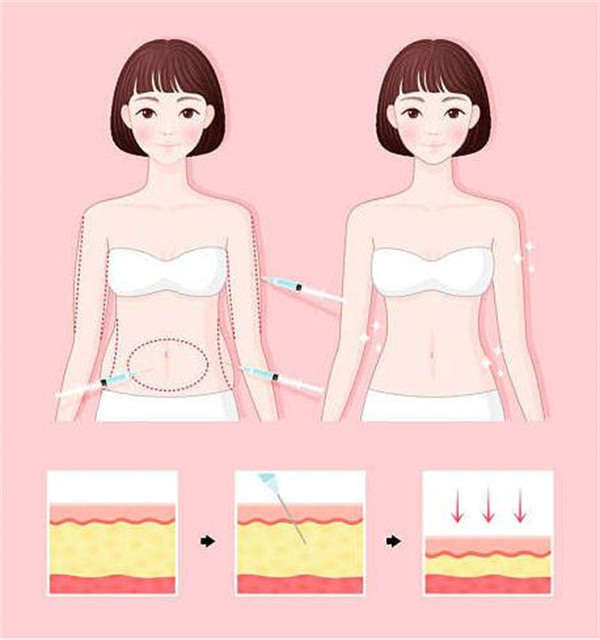 深圳腰腹吸脂价格贵吗？2025行情：1万到5.8万起差在哪？水动力/3D环形技术+关内关外报价对比！