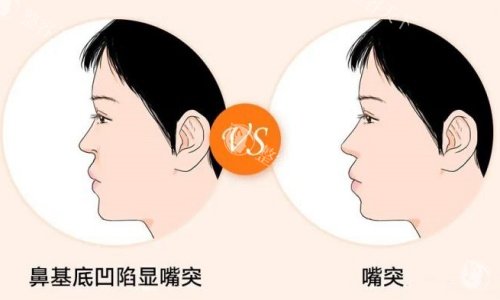 鼻基底凹陷嘴凸示意图