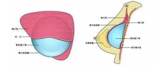 长沙亚韩做胸好不好？郑京湘医生做胸价在6800起，技术口碑在线，审美满足用户需求