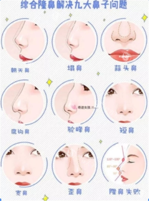 隆鼻