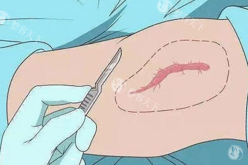 疤痕改善卡通图展示