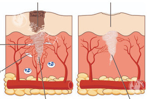 不同情况的疤痕在皮肤上的表现
