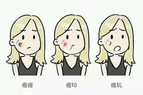 痘印痘坑卡通图