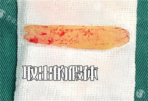 鼻假体取出改善图照片