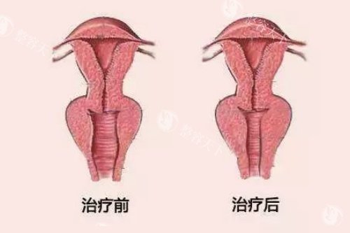 阴道紧缩卡通图