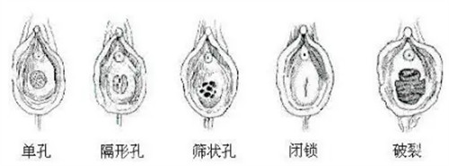 不同形状的处女膜