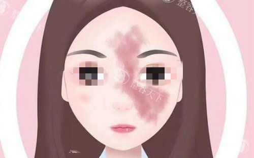 面部胎记示意图