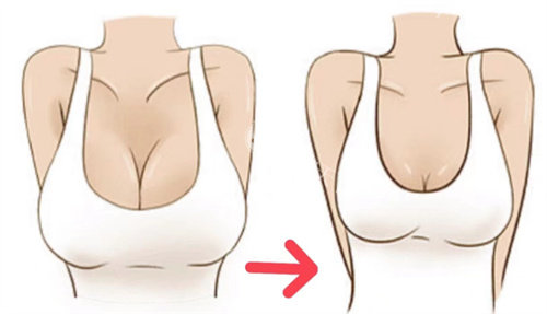 上海巨乳缩小手术价格是多少？大胸缩小费用基本在两三万起步，手术难度和方式直接影响费用