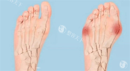 李昕宇医生拇外翻手术好吗？专注足部矫正，手术成效与体验值得关注