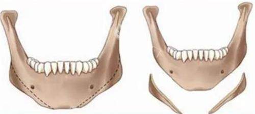 籍建华医生做过多少台手术?轮廓手术上千台纪录!磨骨技术是怎么样?一篇说透!