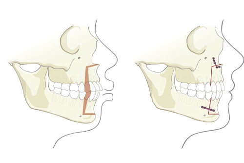 上颌突出对比图