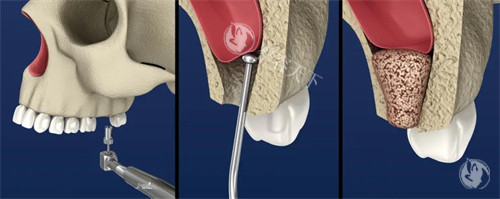 上颌窦提升手术示意图