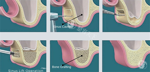 上颌窦提升手术过程