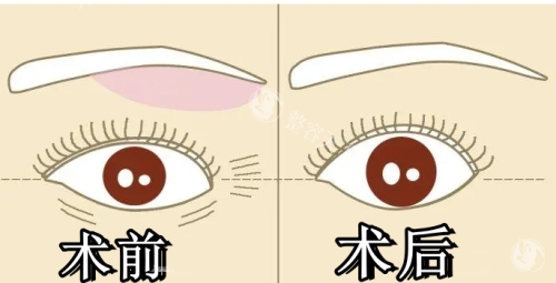 提眉术前术后对比图