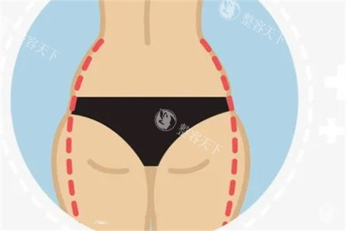 厦门臀部提升价格表2025较新版！埋线提升提升 5000 起 / 手术塑形 8000 起，vs私立医院收费对比