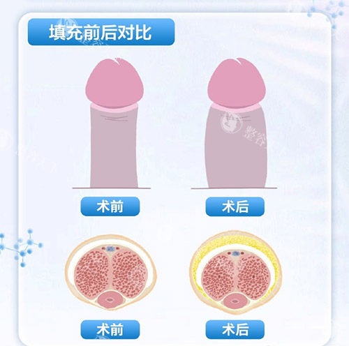 填充增大增粗示意图