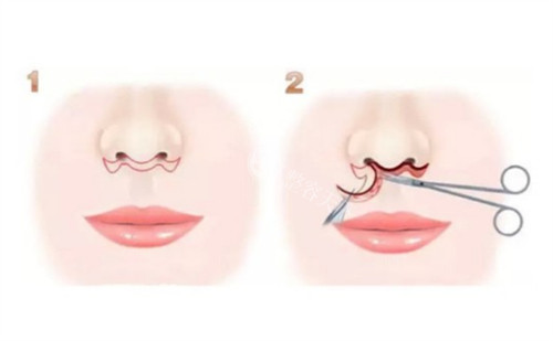 北京王晓健人中缩短怎么样?内切口+肌肉折叠缝合,术后人中窝加深嘴不凸自然如天生