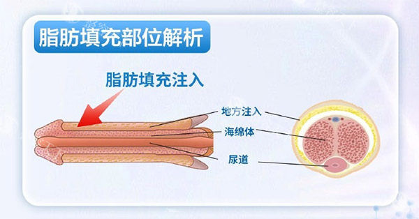 郑州丽天整形自体脂肪填充前后皮肤层动画图