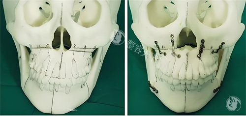2025年重庆肖林做正颌手术价格表已更新：从2.8万到9万起的差价在哪？各术式收费明细一键查询！
