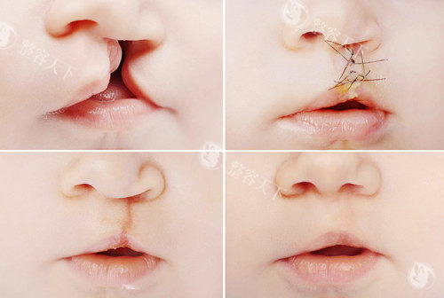 兔唇修复技术国内哪个地区很有名？公布热门的北京/广州/上海/成都地区兔唇修复好的医院医生~