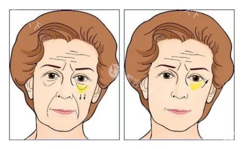 5D胶原光真的有用吗？亲身经历分享术后结果，附上价格和注意事项！