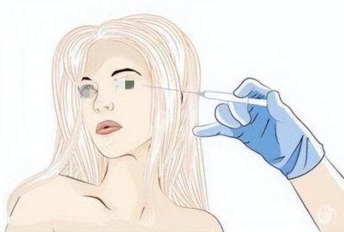 注射胶原蛋白去泪沟示意图