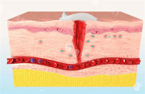 北京美雅枫医院取生长因子多少钱？张立彬医生取生长因子1.2w元起