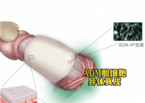 阴茎生物补片ADM材料是什么