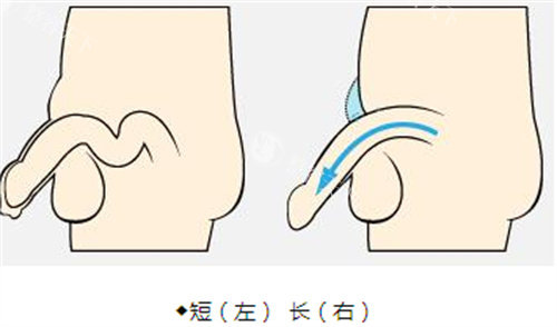 阴茎增长手术前后演示动画图